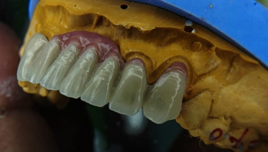 Anterior crowns on the model