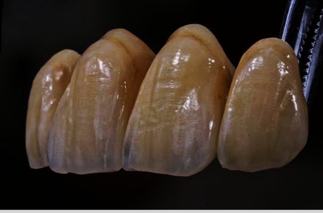 Veneers & Aesthetics