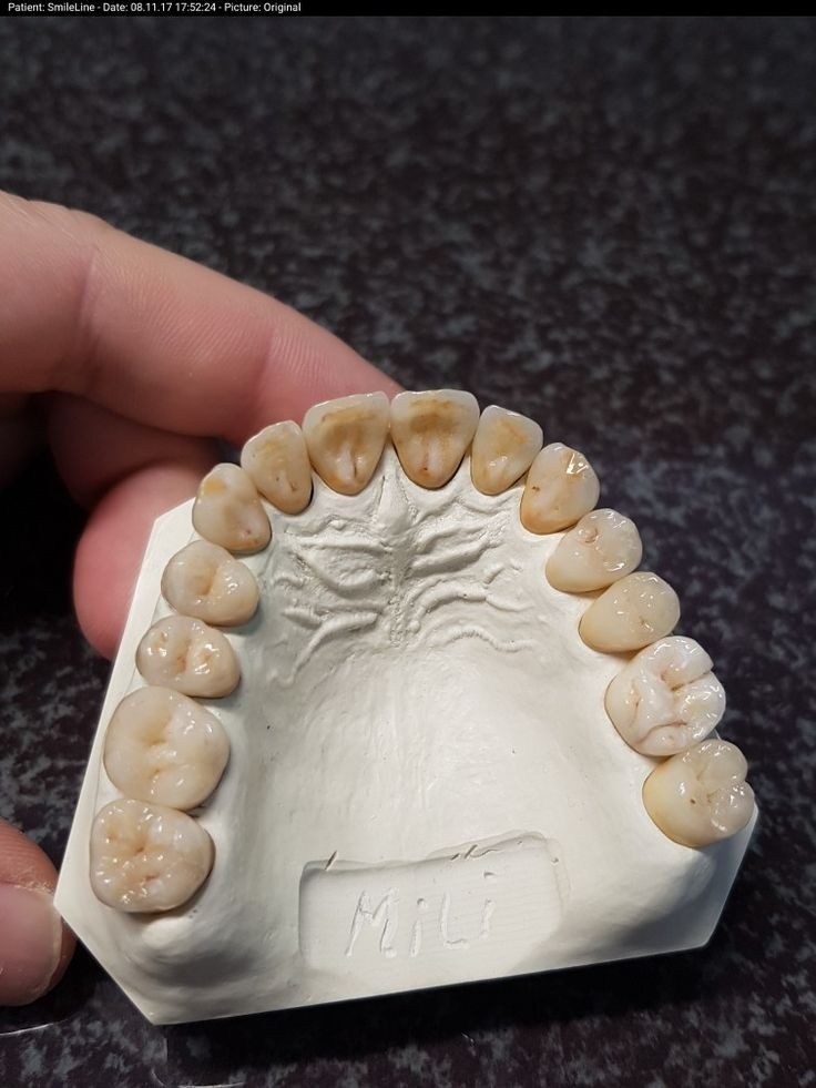 Removable Prosthetics